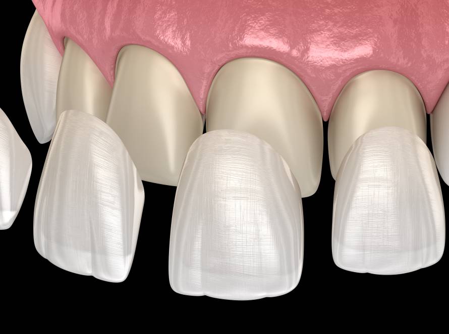 Veneer installation
