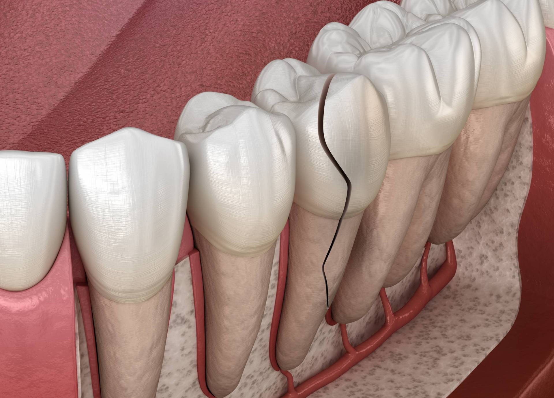 DENTAL BONDING