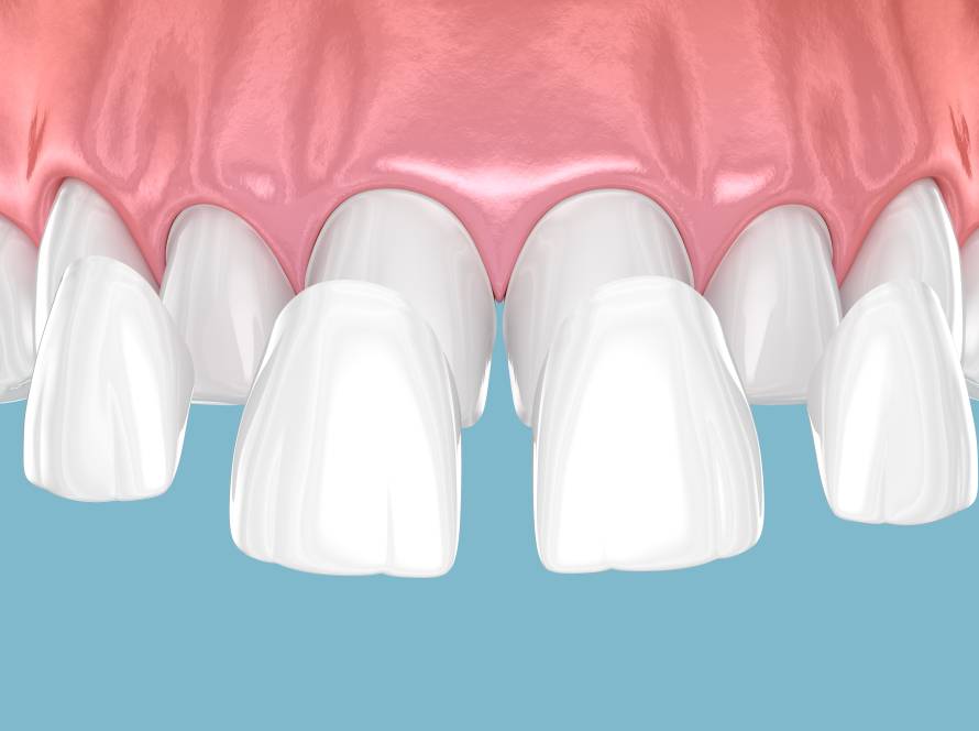 Dental veneer placement over frontal teeth. 3D illustration