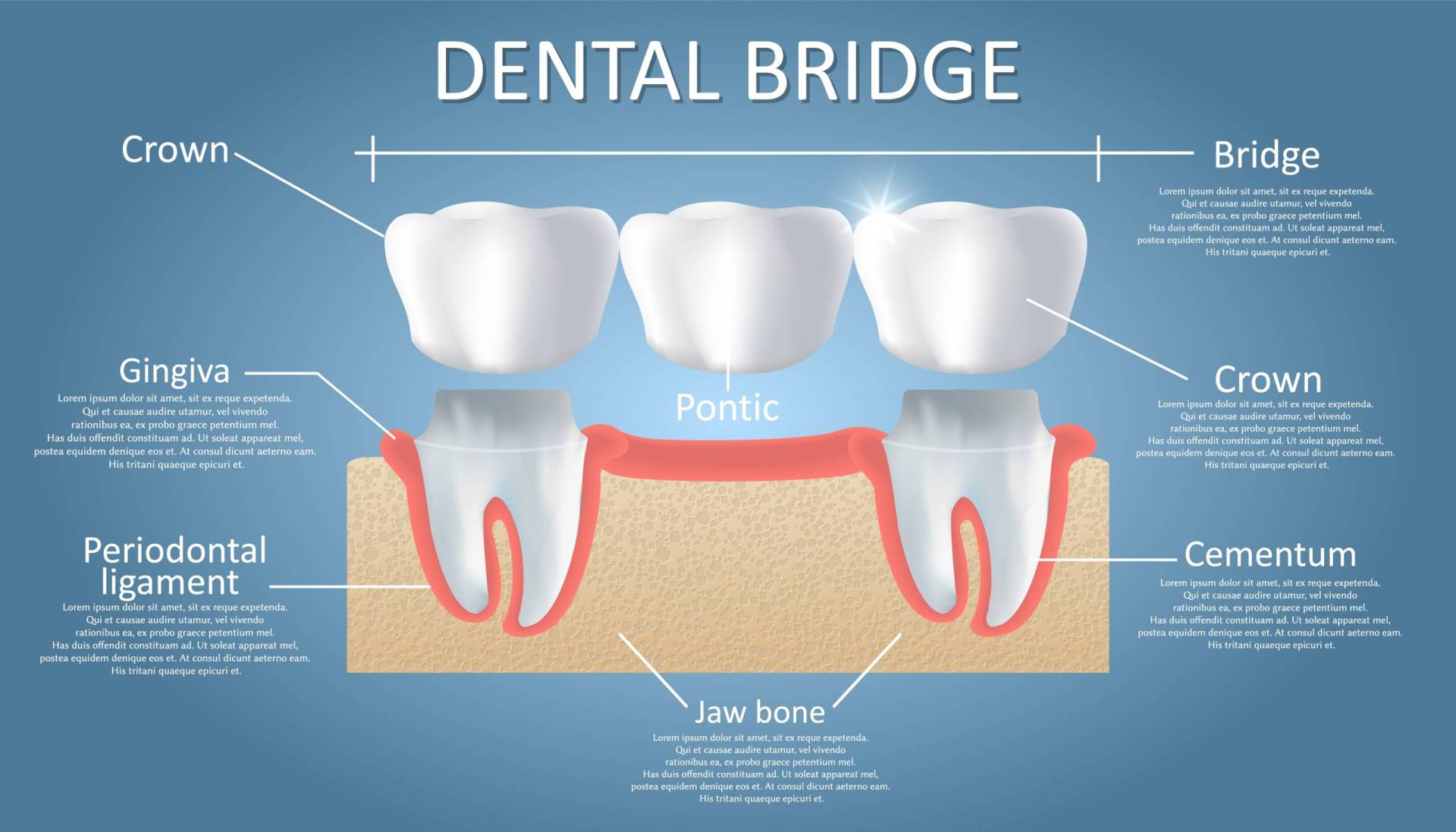 Dental bridge concept vector educational poster, diagram