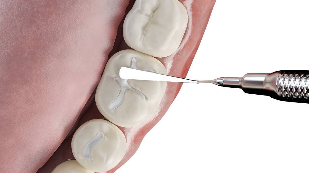 Dental Fillings in Newton, NJ