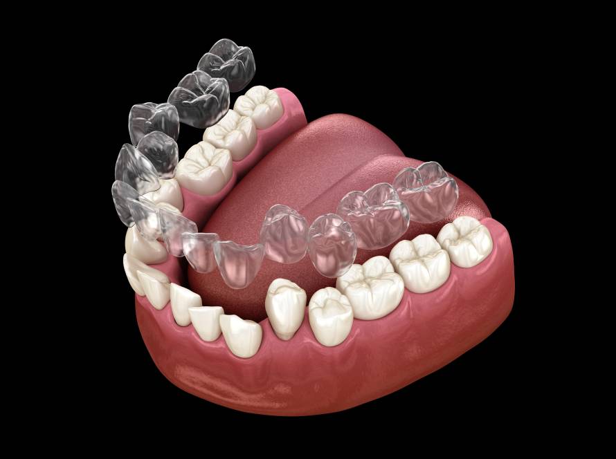 Invisalign vs Braces