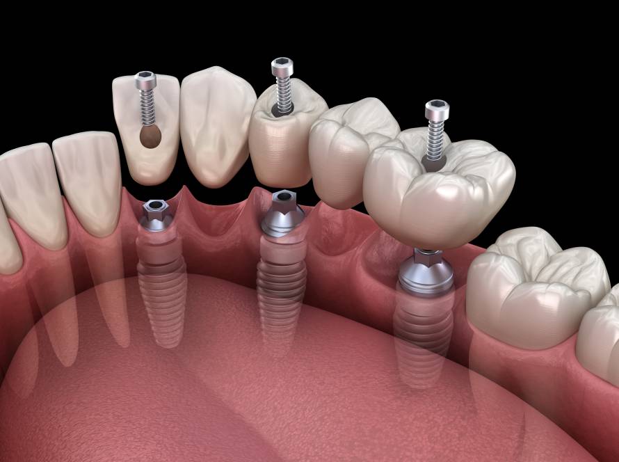 Dental Bridges