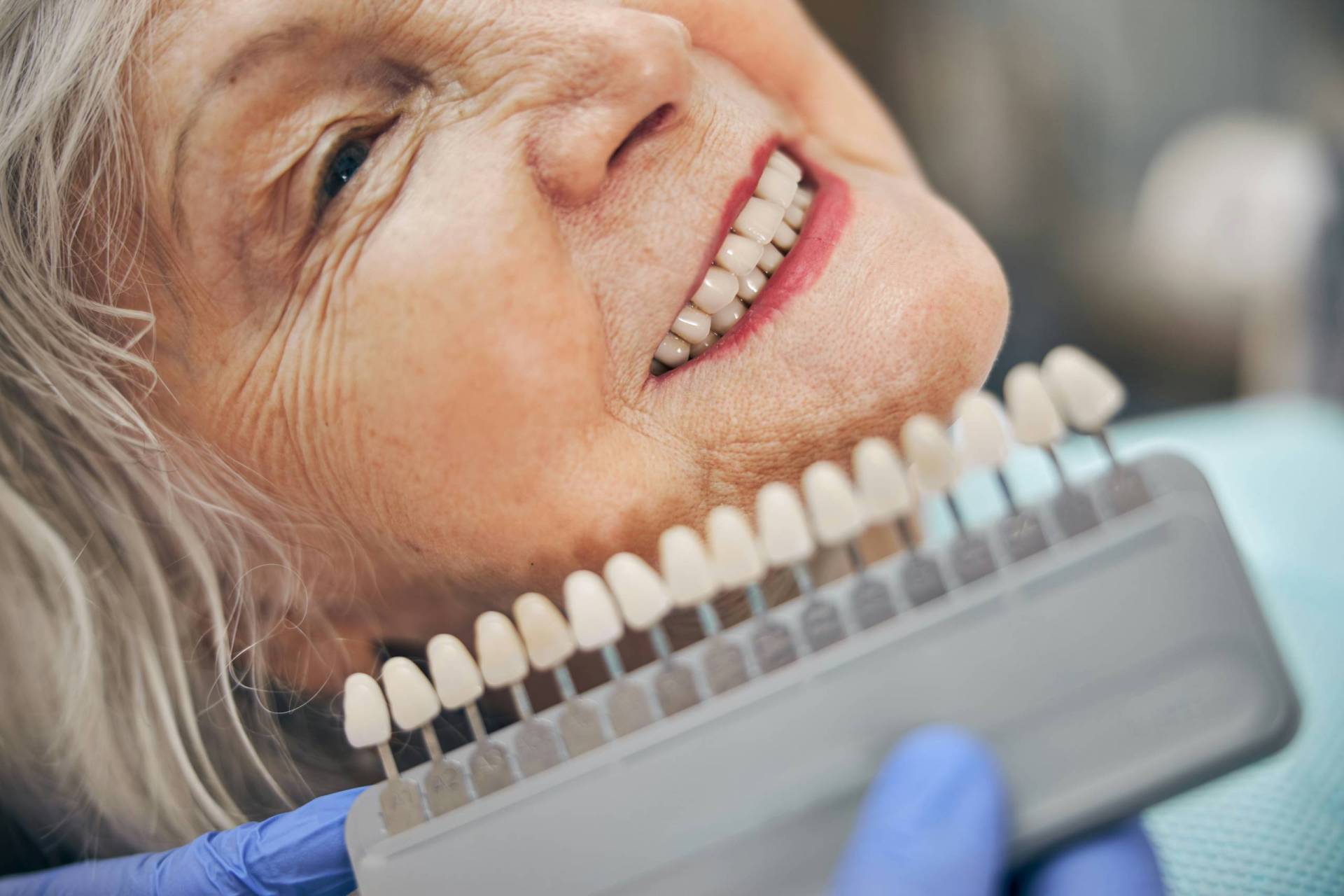 Veneers