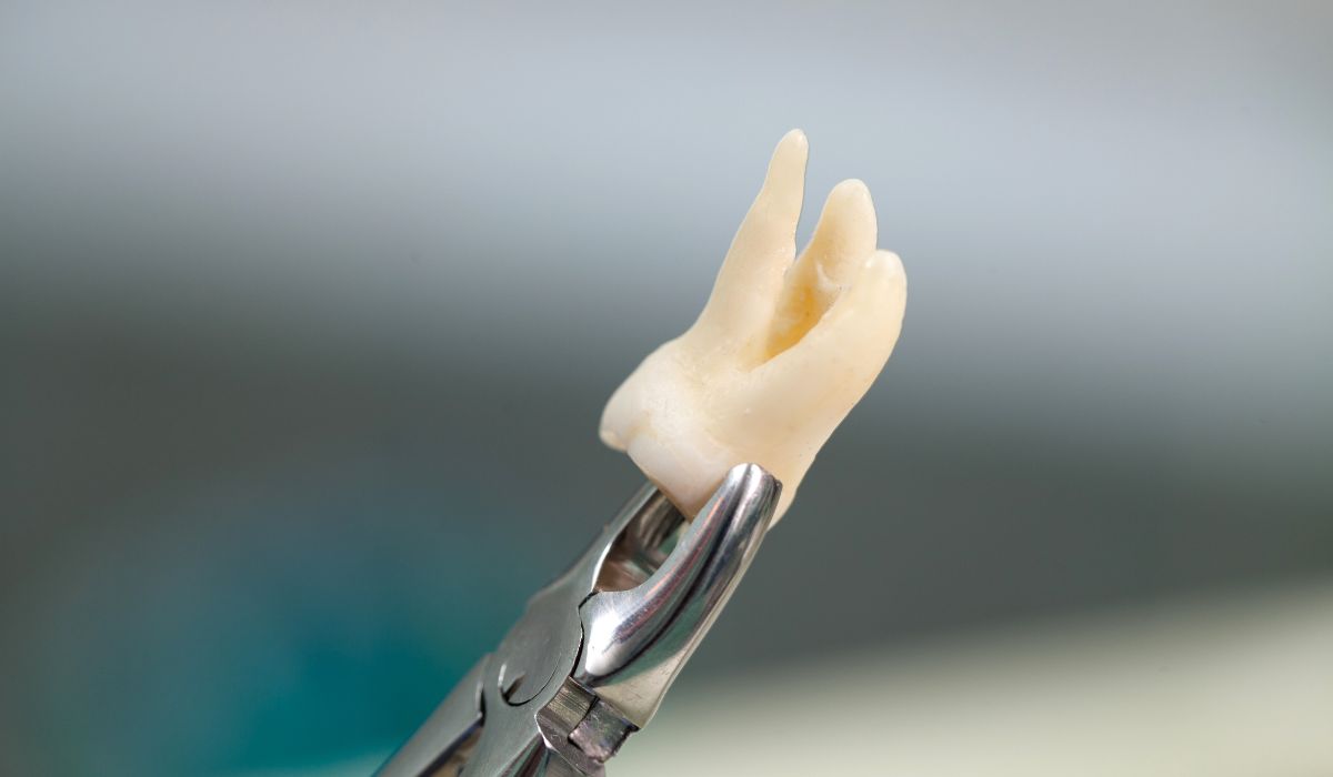 Wisdom Teeth infection after removal