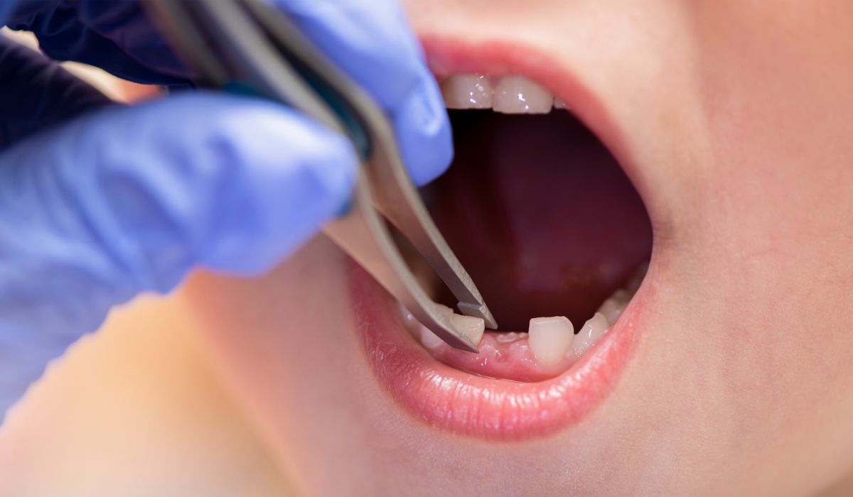 How Long Does Tooth Extraction Take To Heal