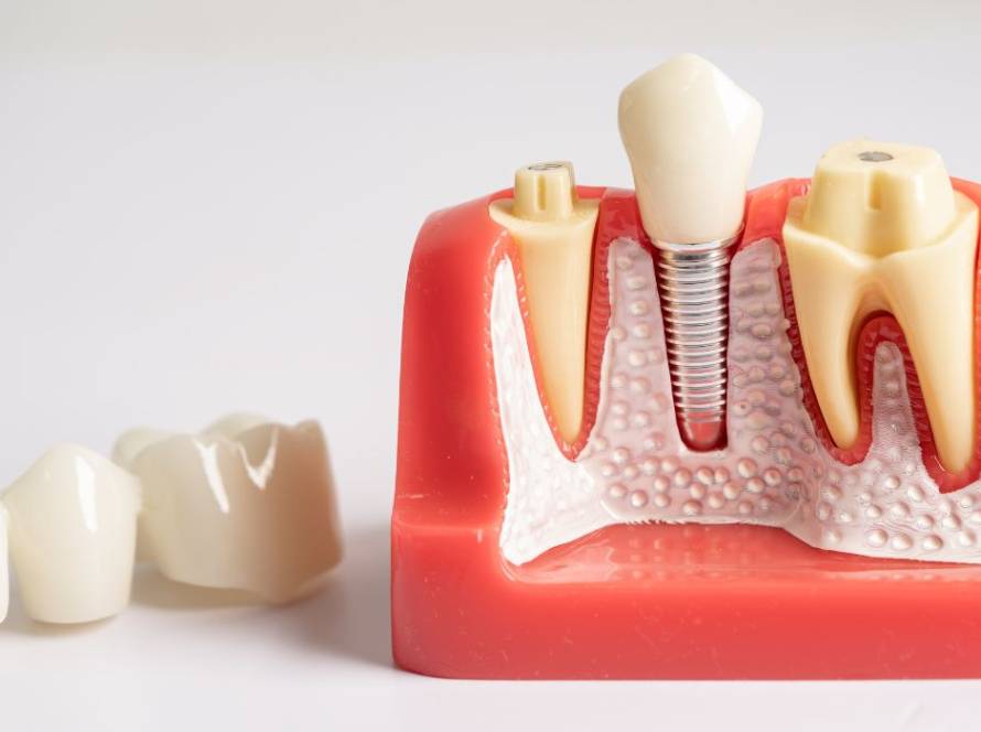 What To Expect Before and After a Root Canal