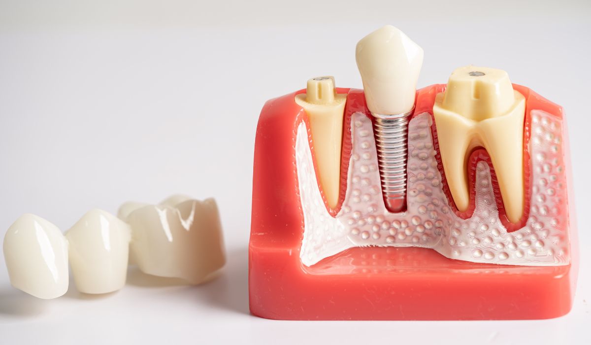 What To Expect Before and After a Root Canal