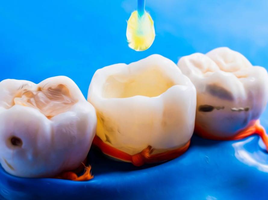 Porcelain Fillings vs. Composite Fillings