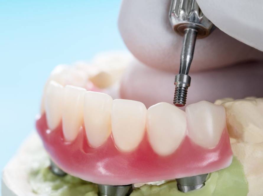 All On X Dental Implants