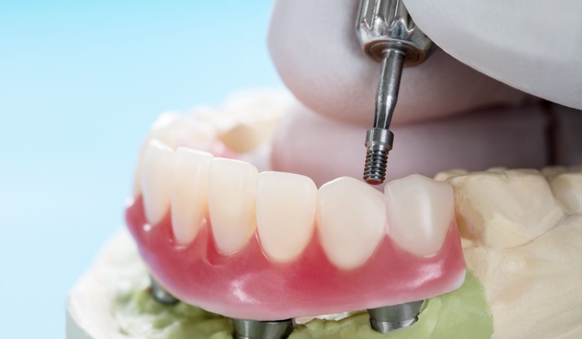 All On X Dental Implants